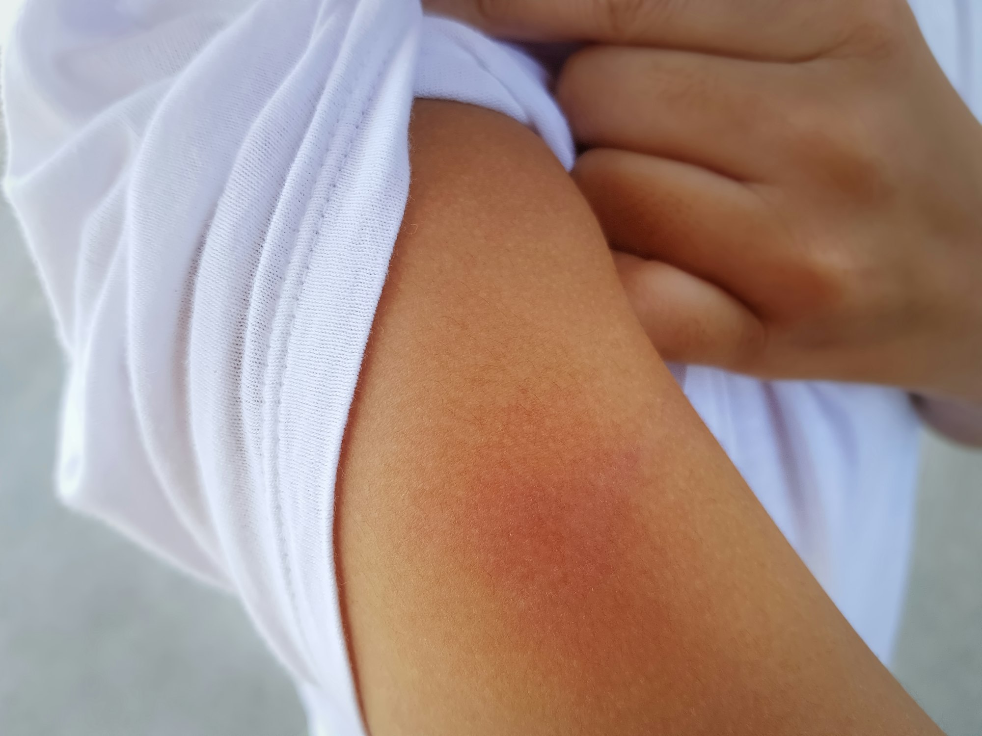 Teenager in White Casual Clothing Showing Red Arm Rash